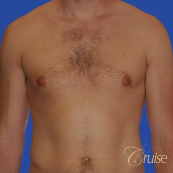 Male breast reduction performed to get rid of puffy nipples after 3502243