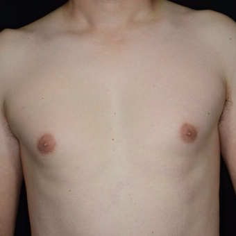 25-34 year old woman treated with Male Breast Reduction before 3099170