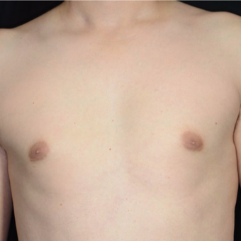 25-34 year old woman treated with Male Breast Reduction after 3099170