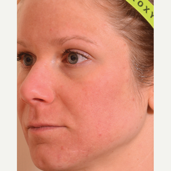 Halo Laser after 1833348