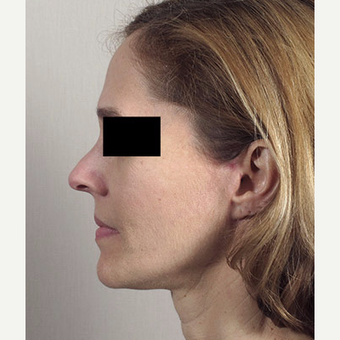 45-54 year old woman treated with Facelift after 3213128