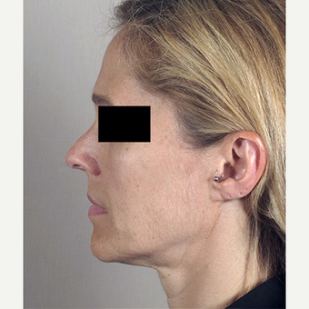 45-54 year old woman treated with Facelift before 3213128