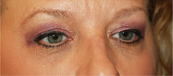 Eye Bag Surgery 886789