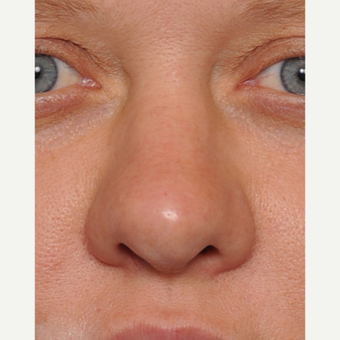 35-44 year old woman treated with Revision Rhinoplasty before 3438431