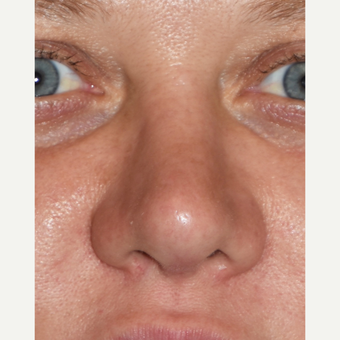 35-44 year old woman treated with Revision Rhinoplasty after 3438431