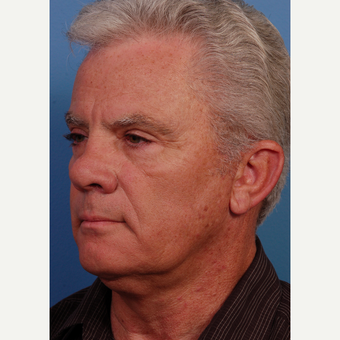 55-64 year old man treated with Facelift after 3454022