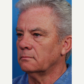 55-64 year old man treated with Facelift before 3454022