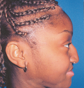 Ethnic Rhinoplasty 529786