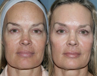 Fraxel Repair for sun damage and wrinkles before 103862