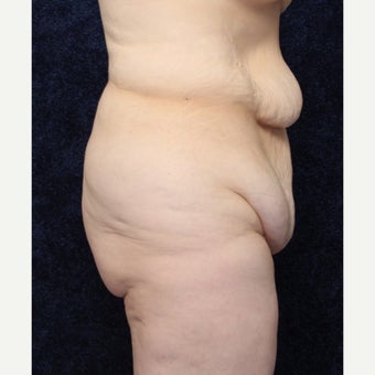 36 year old woman treated with Body Lift (Beltlift) and Medial Thigh Lift 1642350