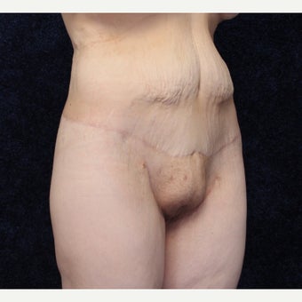 36 year old woman treated with Body Lift (Beltlift) and Medial Thigh Lift after 1642350
