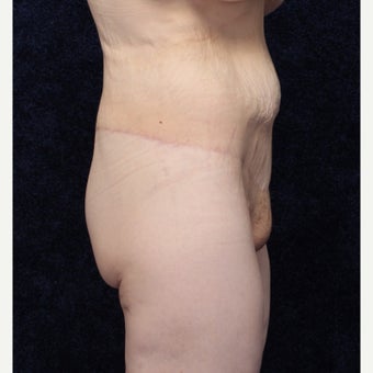 36 year old woman treated with Body Lift (Beltlift) and Medial Thigh Lift 1642350