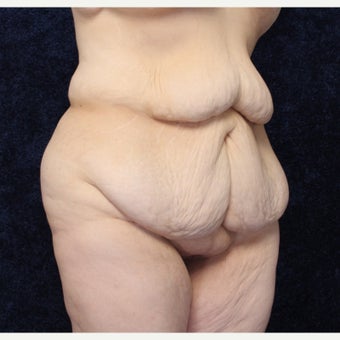 36 year old woman treated with Body Lift (Beltlift) and Medial Thigh Lift before 1642350