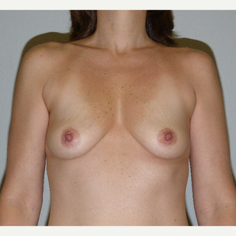 35-44 year old woman treated with gummy bear Breast Augmentation before 2995873