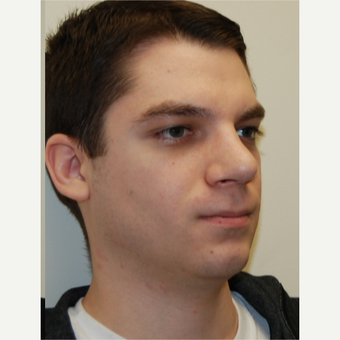 25-34 year old man treated with Rhinoplasty after 3792789