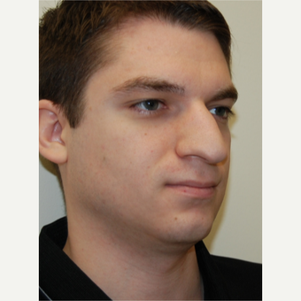 25-34 year old man treated with Rhinoplasty before 3792789
