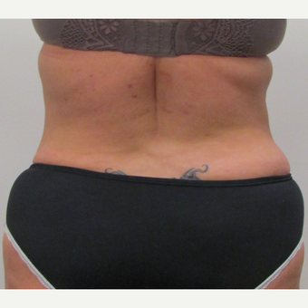 Liposuction of the Love Handles for This 42 Year Old Woman after 3387235