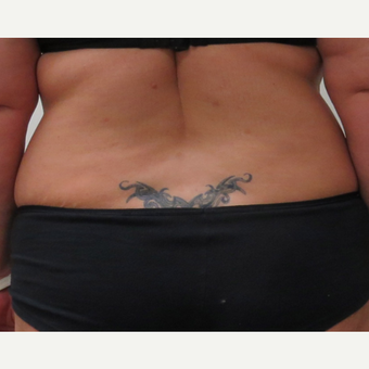 Liposuction of the Love Handles for This 42 Year Old Woman before 3387235