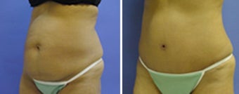 Tummy Tuck left side view before 8965