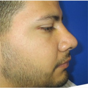Rhinoplasty after 2993734