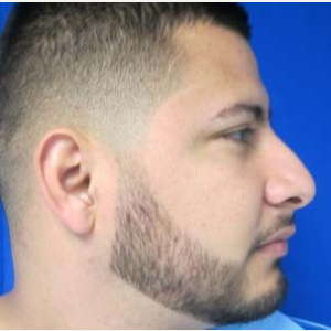 Rhinoplasty before 2993734
