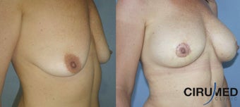 Breast augmentation after 1333110