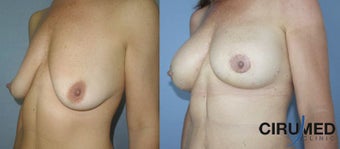 Breast augmentation 1333110