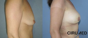 Breast augmentation 1333110