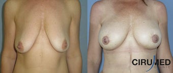 Breast augmentation before 1333110