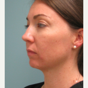 25-34 year old woman treated with Bellafill before 3237130