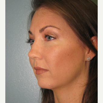 25-34 year old woman treated with Bellafill after 3237130