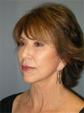 LiteLift™, Platysmaplasty, Blue Peel® on 62-year-old Woman 1149669