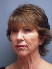 LiteLift™, Platysmaplasty, Blue Peel® on 62-year-old Woman 1149669