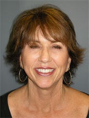 LiteLift™, Platysmaplasty, Blue Peel® on 62-year-old Woman after 1149669
