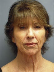 LiteLift™, Platysmaplasty, Blue Peel® on 62-year-old Woman before 1149669