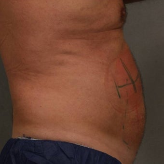55-64 year old man treated with CoolSculpting before 1612047