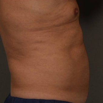 55-64 year old man treated with CoolSculpting after 1612047