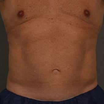 55-64 year old man treated with CoolSculpting 1612047