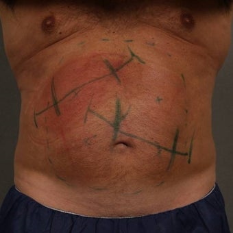 55-64 year old man treated with CoolSculpting 1612047