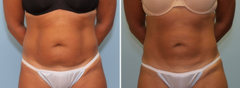 Vaser Lipo Abdomen before 912950