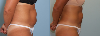 Vaser Lipo Abdomen after 912950