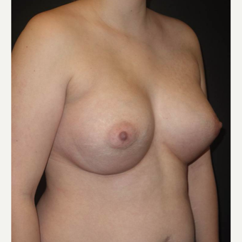 18-24 year old woman treated with Breast Implants after 3458281