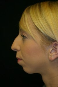 Rhinoplasty and Chin Implant before 512573