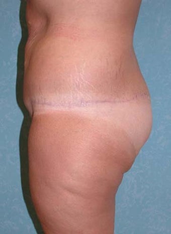 Circumferential Body Lift with Buttock Augmentation 856899