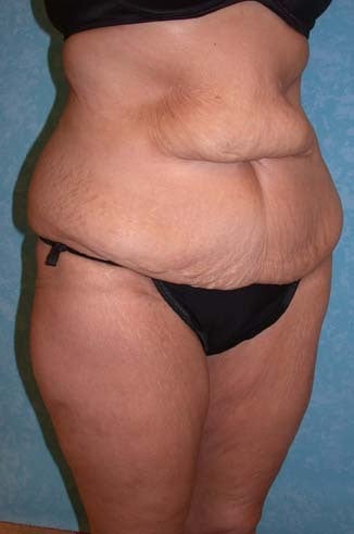 Circumferential Body Lift with Buttock Augmentation before 856899