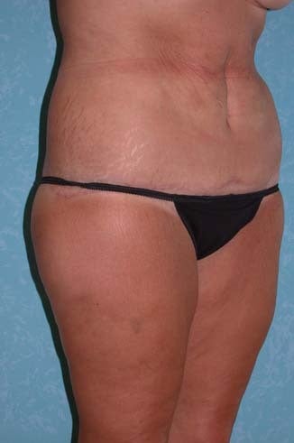 Circumferential Body Lift with Buttock Augmentation after 856899