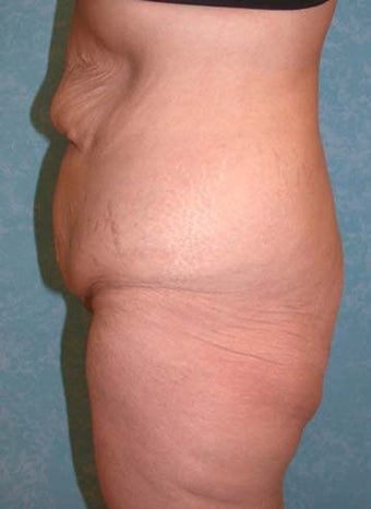 Circumferential Body Lift with Buttock Augmentation 856899