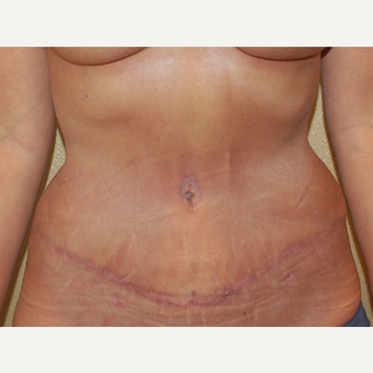 45-54 year old woman treated with Mommy Makeover after 3365607