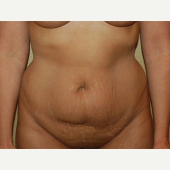 45-54 year old woman treated with Mommy Makeover before 3365607