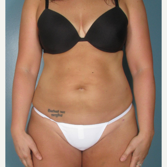 25-34 year old woman treated with Smart Lipo after 3237027